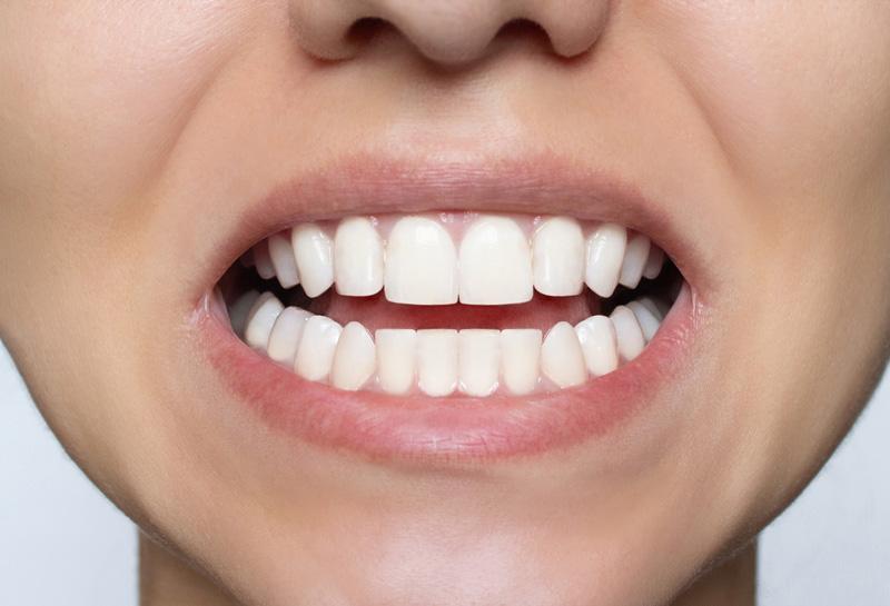 Ορθοδοντική θεραπεία Invisalign μετά - TK Orthodontics