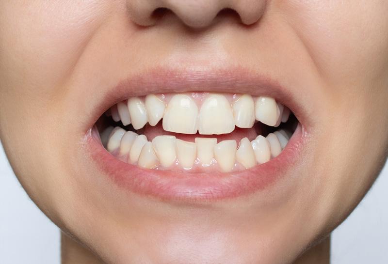 Ορθοδοντική θεραπεία Invisalign πριν - TK Orthodontics