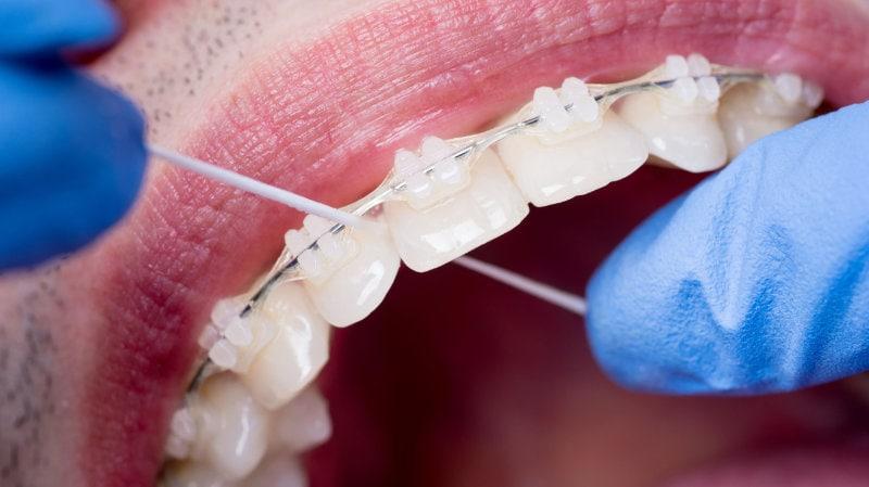 Κεραμικά σιδεράκια - Ορθοδοντικός Αθήνα TK Orthodontics