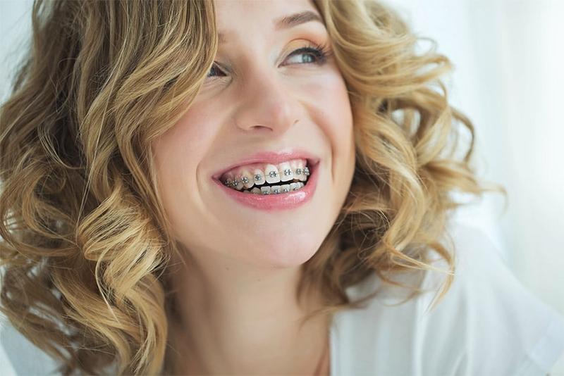 Μεταλλικά σιδεράκια - Ορθοδοντικός Αθήνα TK Orthodontics